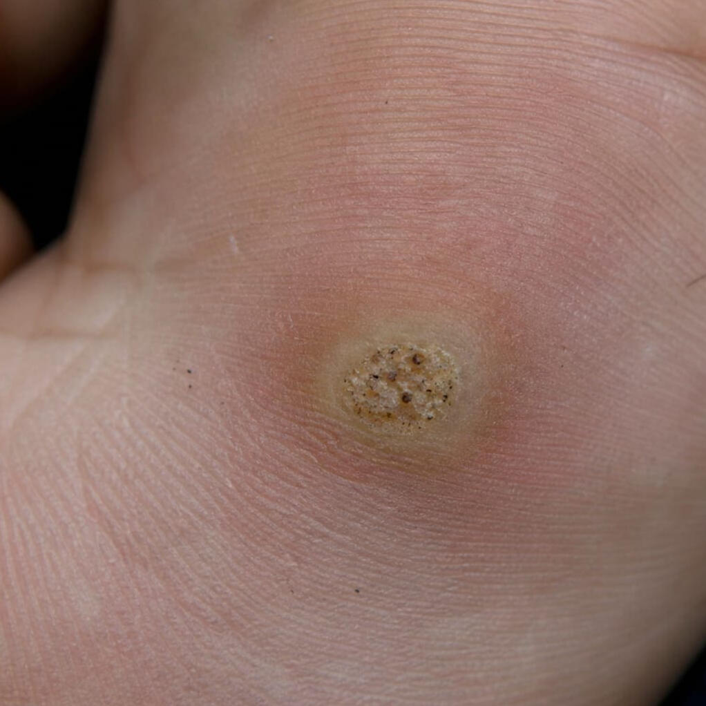 verrugas plantares